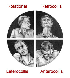 The turning of the head is generally considered to fall into one of four categories...